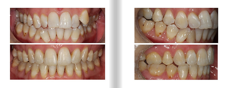 Class I Extractions 4's