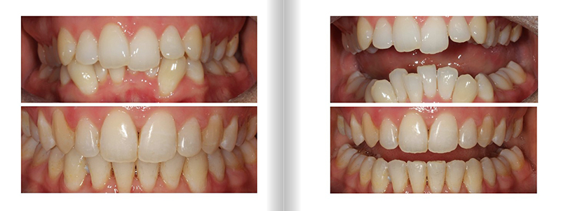 Crowding Anterior