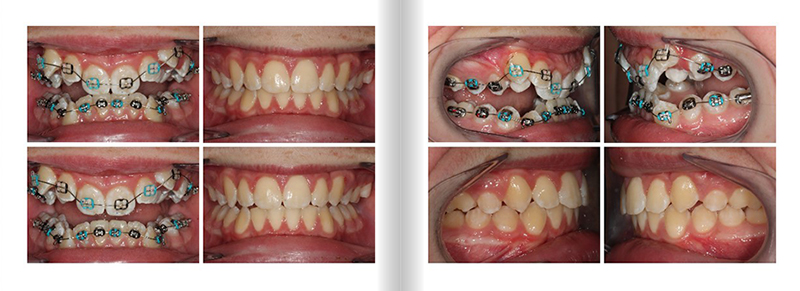 Extractions Upper 4's