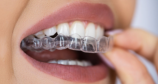 A person fitting a clear orthodontic aligner over their upper teeth, commonly used in Invisalign treatments.
