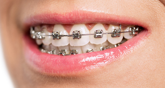 Close-up of a smiling mouth with traditional metal braces on the teeth.