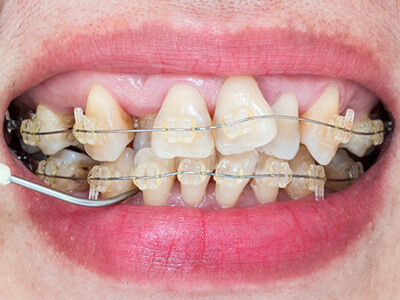 Close-up image of a dental implant procedure in progress, showing an implant post being placed in the jaw.