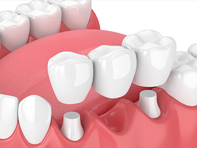 A 3D rendering of dental braces with brackets on the upper teeth, illustrating orthodontic treatment.