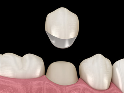 A 3D illustration of a dental crown being placed over a lower tooth.