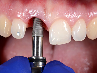 Close-up of a dental implant procedure in progress.