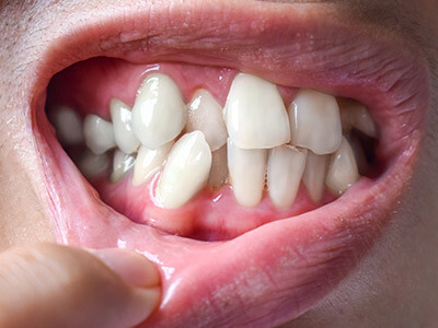 A close-up of an open mouth revealing an impacted tooth pushing against the adjacent teeth.