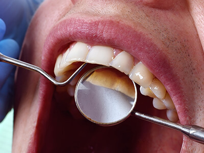 "A close-up of a dental examination showing a tooth with a filling, as seen through a dental mirror. "