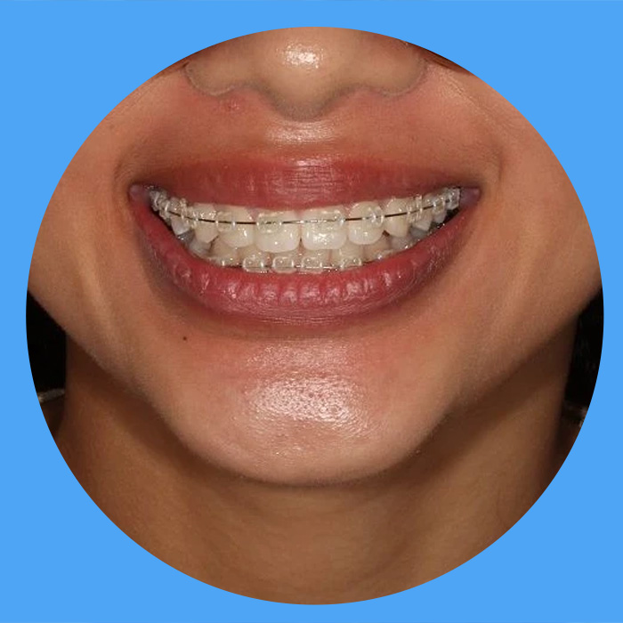 https://www.adelaidebraces.com.au/wp-content/uploads/2024/03/6mth-banner.jpg