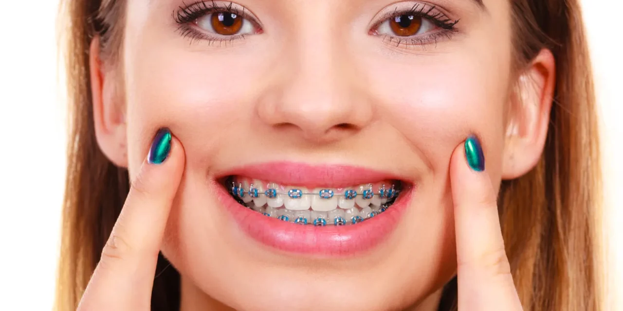Adelaide Braces: Perfecting Your Smile and Eye Teeth