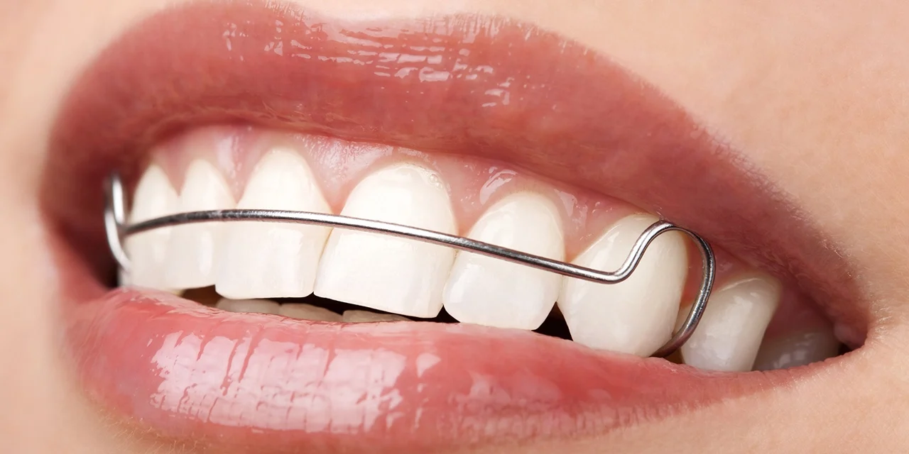 Life After Braces: Why Retainers Are Non-Negotiable
