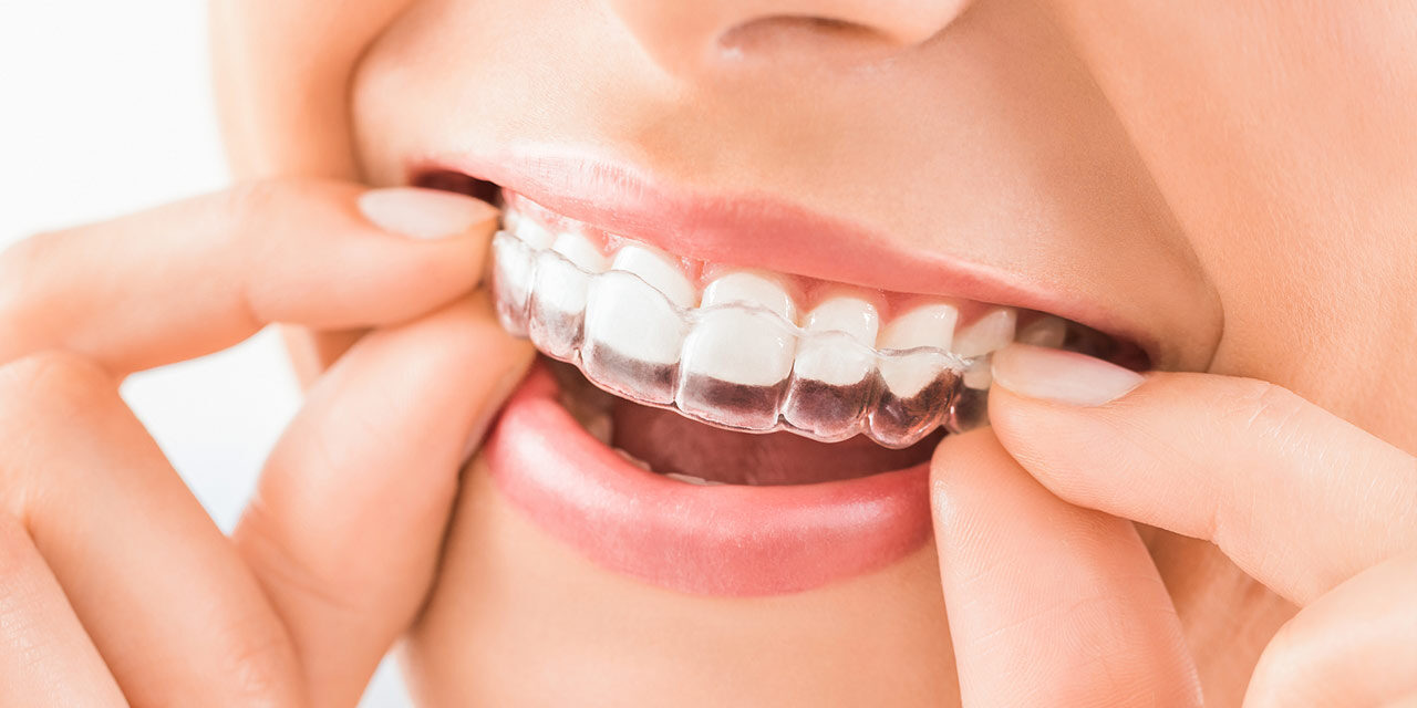 Life After Braces: Why Retainers Are Non-Negotiable