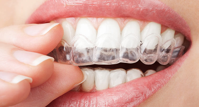 Does Invisalign Really Work? Here’s What Adelaide Patients Should Know