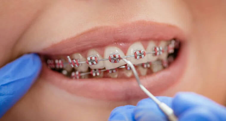 Does Private Health Insurance Cover Orthodontic Treatment in Adelaide?